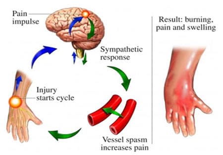 Reflex sympathetic dystrophy treatment at Sports Pain Institute NYC — Dr. Febin Melepura
