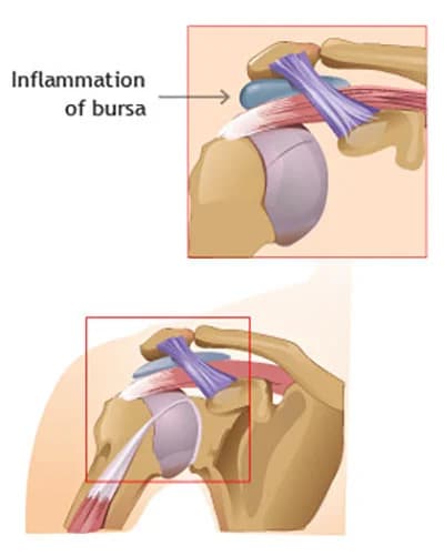 Shoulder bursitis treatment doctor specialist NYC — Dr. Febin Melepura