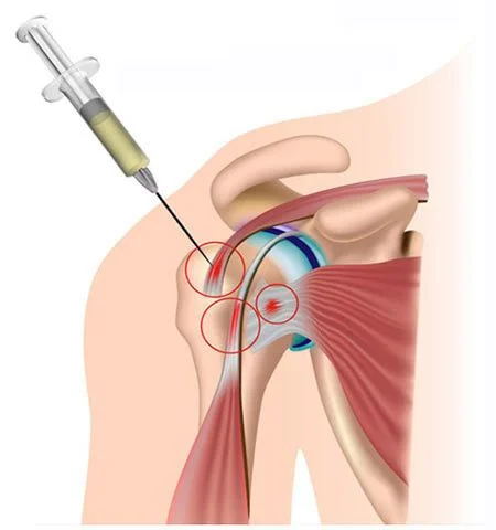 Cortisone shoulder joint injection at Sports Pain Institute NYC — Dr. Febin Melepura