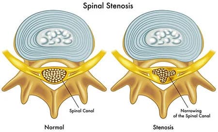Spinal stenosis treatment doctor spine specialist NYC — Dr. Febin Melepura