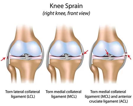 Sprained knee treatment doctor specialist NYC — Dr. Febin Melepura