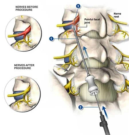Sympathetic nerve block injection for lower back pain at Sports Pain Institute NYC — Dr. Febin Melepura