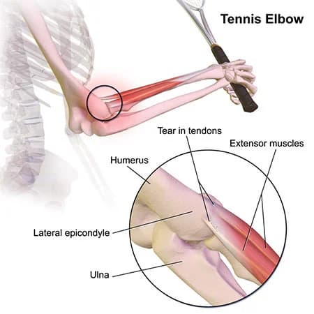 Tennis elbow treatment doctor specialist NYC — Dr. Febin Melepura