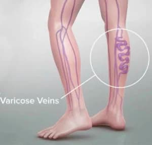 Varicose vein treatment doctor specialist NYC — Dr. Febin Melepura