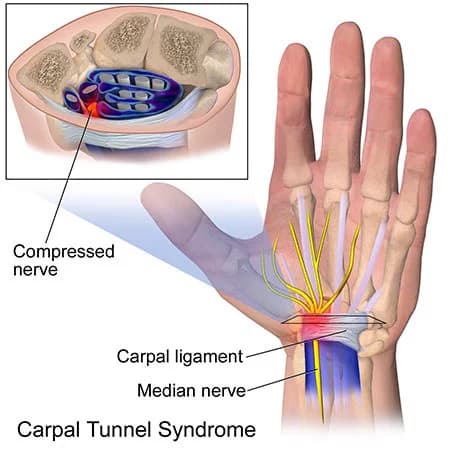 Wrist pain treatment doctor specialist NYC — Dr. Febin Melepura